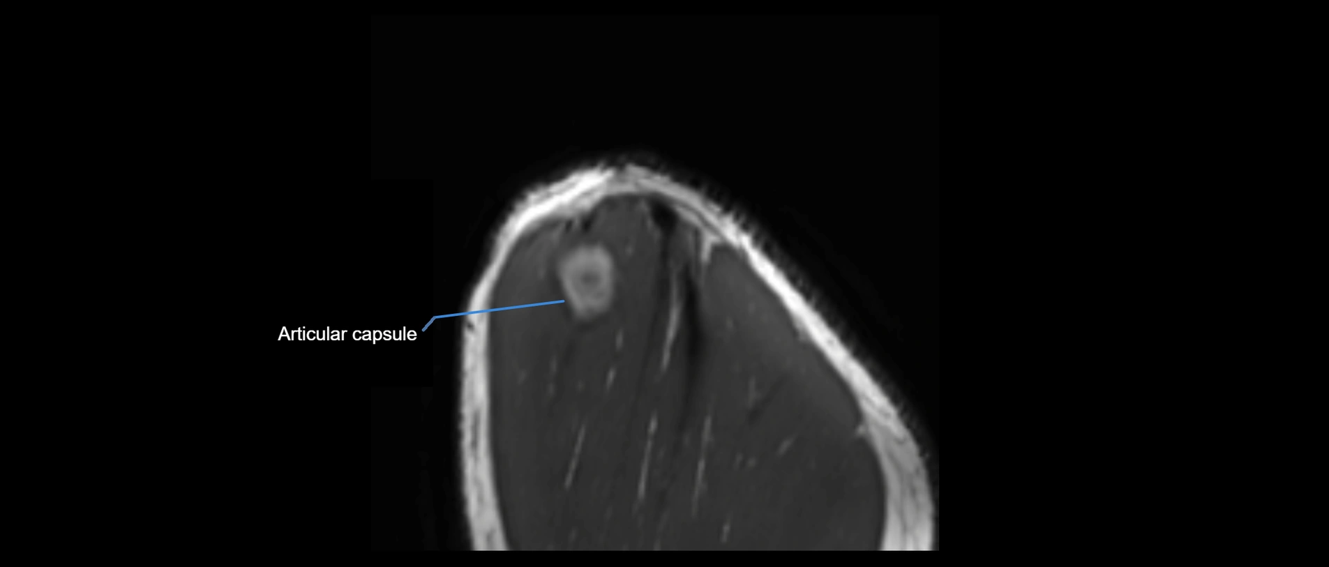 shoulder ligaments sagittal  cross sectional anatomy 3T MRI AI enhanced radiology image -img-00001-00058.webp